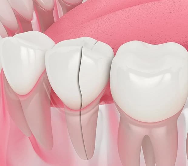 Types of Dental Root Fractures