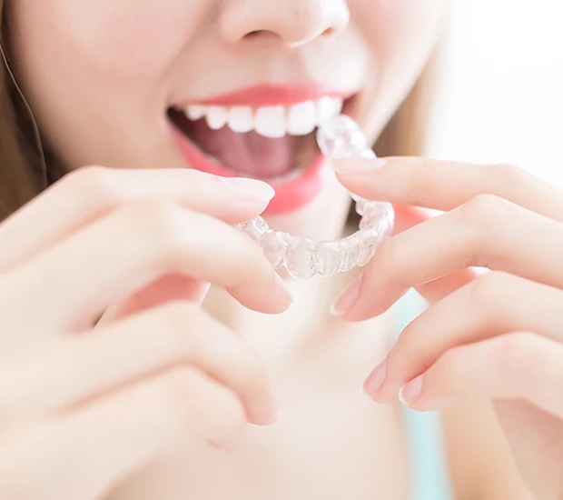 alternative to braces